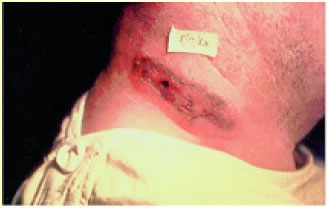 Δερματικός άνθρακας