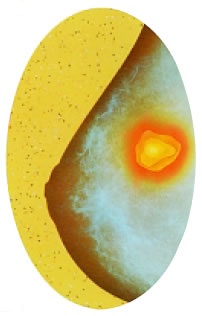 Εικόνα 1.43: Καρκίνος του μαστού