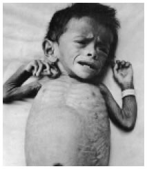 Παιδί υποσιτισμένο